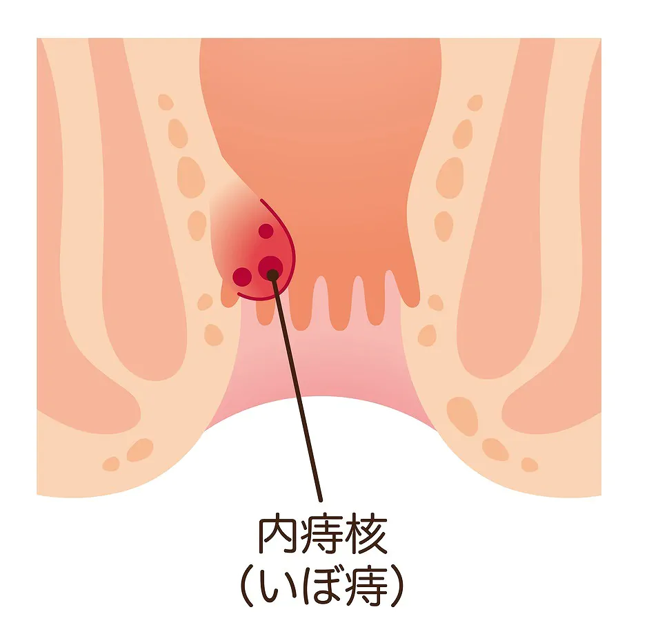 内痔核（いぼ痔）