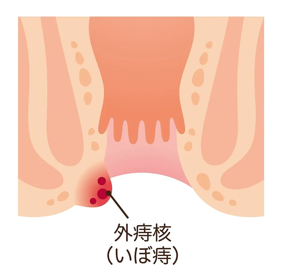 外痔核（いぼ痔）