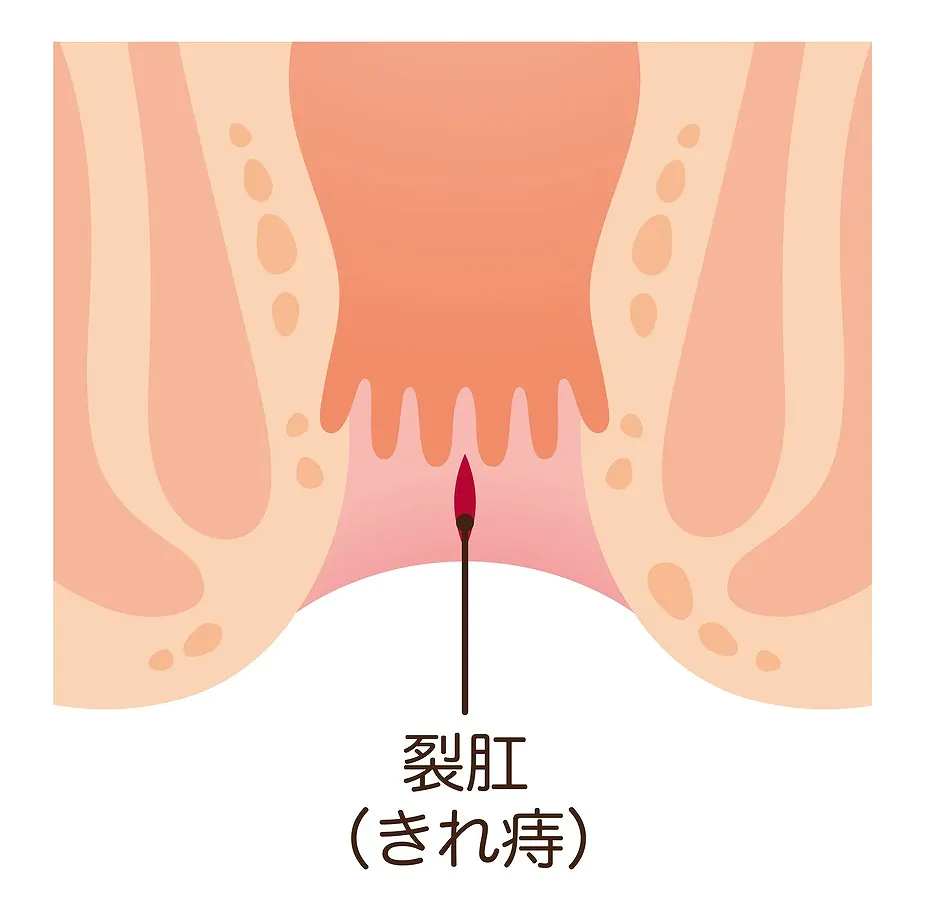 裂肛（切れ痔）