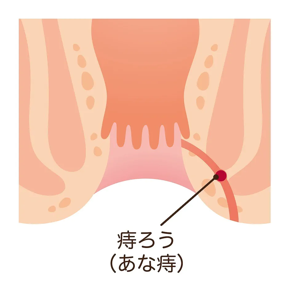 痔ろう（あな痔）