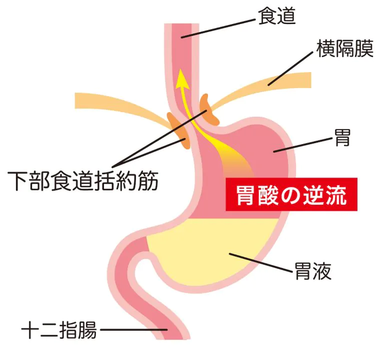 逆流性胃腸炎